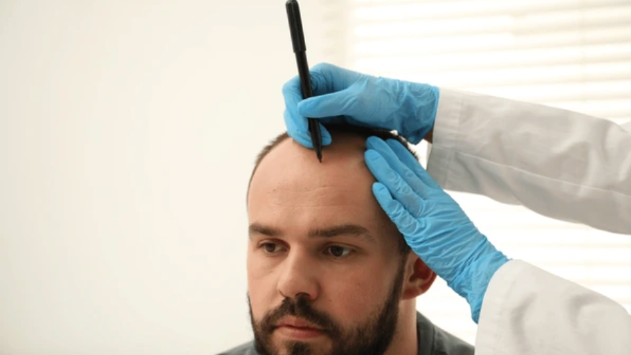 Comprendre la greffe capillaire FUE : technique et résultats